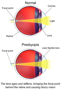 What's the Best Age for LASIK? - Pacific Eye Associates