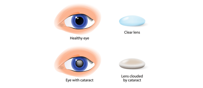 Cataract Surgery Which Is The Better Lens Multifocal Or Monofocal